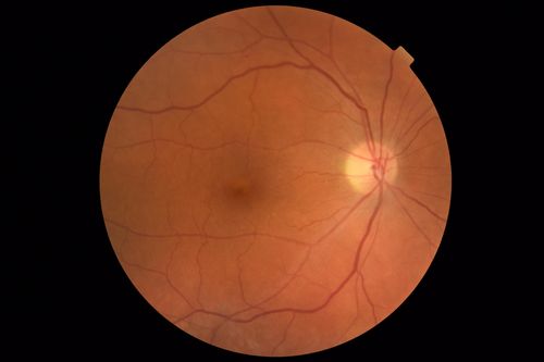 Central Retinal Vein Occlusion with Macular Edema
74 year old female The vision in the left eye has gotten worse over the last 3 weeks.  
VA OD: Dcc20/25 
VA OS: DccCF 3ft 
IOP: TP: OD:16 OS:14 
Vision improved to 20/40 in 3 months with monthly Aflibercept
