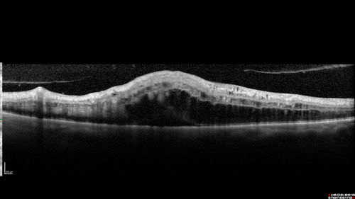 Central Retinal Vein Occlusion with Macular Edema
74 year old female The vision in the left eye has gotten worse over the last 3 weeks.  
VA OD: Dcc20/25 
VA OS: DccCF 3ft 
IOP: TP: OD:16 OS:14 
Vision improved to 20/40 in 3 months with monthly Aflibercept
