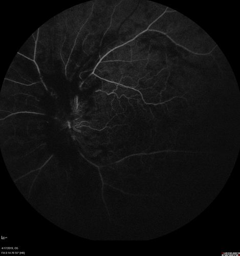 Central Retinal Vein Occlusion with Macular Edema
74 year old female The vision in the left eye has gotten worse over the last 3 weeks.  
VA OD: Dcc20/25 
VA OS: DccCF 3ft 
IOP: TP: OD:16 OS:14 
Vision improved to 20/40 in 3 months with monthly Aflibercept
