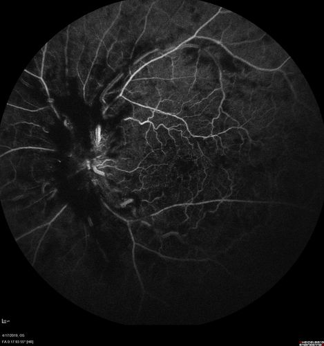 Central Retinal Vein Occlusion with Macular Edema
74 year old female The vision in the left eye has gotten worse over the last 3 weeks.  
VA OD: Dcc20/25 
VA OS: DccCF 3ft 
IOP: TP: OD:16 OS:14 
Vision improved to 20/40 in 3 months with monthly Aflibercept
