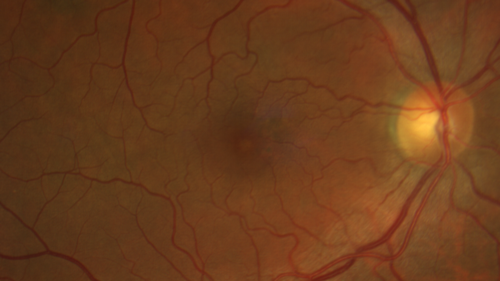 Mild Central Serous Chorioretinopathy - Flonase related
58 year old man with vision loss in the left eye for 8 days.  This has never happened before. He started taking flonase about a month ago.  He stopped the flonase and the vision improved in less than a month.  Initial vision was 20/20 OD, 20/40 OS
