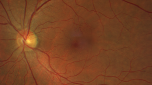 Mild Central Serous Chorioretinopathy - Flonase related
58 year old man with vision loss in the left eye for 8 days.  This has never happened before. He started taking flonase about a month ago.  He stopped the flonase and the vision improved in less than a month.  Initial vision was 20/20 OD, 20/40 OS
