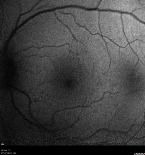 Mild Central Serous Chorioretinopathy - Flonase related
58 year old man with vision loss in the left eye for 8 days.  This has never happened before. He started taking flonase about a month ago.  He stopped the flonase and the vision improved in less than a month.  Initial vision was 20/20 OD, 20/40 OS
