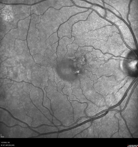 Mild Central Serous Chorioretinopathy - Flonase related
58 year old man with vision loss in the left eye for 8 days.  This has never happened before. He started taking flonase about a month ago.  He stopped the flonase and the vision improved in less than a month.  Initial vision was 20/20 OD, 20/40 OS
