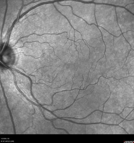 Mild Central Serous Chorioretinopathy - Flonase related
58 year old man with vision loss in the left eye for 8 days.  This has never happened before. He started taking flonase about a month ago.  He stopped the flonase and the vision improved in less than a month.  Initial vision was 20/20 OD, 20/40 OS
