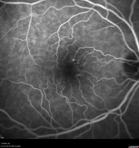 Mild Central Serous Chorioretinopathy - Flonase related
58 year old man with vision loss in the left eye for 8 days.  This has never happened before. He started taking flonase about a month ago.  He stopped the flonase and the vision improved in less than a month.  Initial vision was 20/20 OD, 20/40 OS
