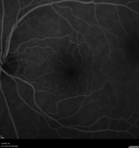 Mild Central Serous Chorioretinopathy - Flonase related
58 year old man with vision loss in the left eye for 8 days.  This has never happened before. He started taking flonase about a month ago.  He stopped the flonase and the vision improved in less than a month.  Initial vision was 20/20 OD, 20/40 OS
