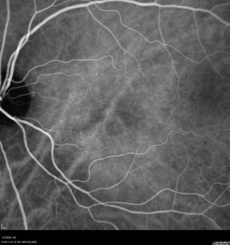 Mild Central Serous Chorioretinopathy - Flonase related
58 year old man with vision loss in the left eye for 8 days.  This has never happened before. He started taking flonase about a month ago.  He stopped the flonase and the vision improved in less than a month.  Initial vision was 20/20 OD, 20/40 OS
