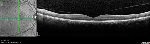 Mild Central Serous Chorioretinopathy - Flonase related
58 year old man with vision loss in the left eye for 8 days.  This has never happened before. He started taking flonase about a month ago.  He stopped the flonase and the vision improved in less than a month.  Initial vision was 20/20 OD, 20/40 OS
