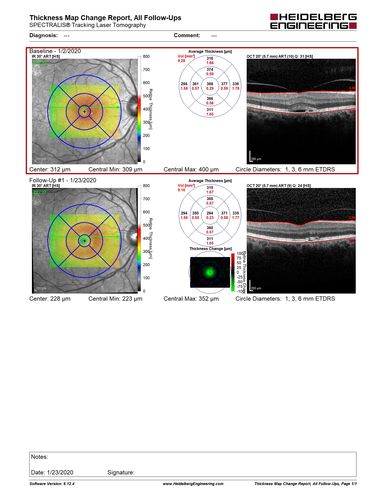 Mild Central Serous Chorioretinopathy - Flonase related
58 year old man with vision loss in the left eye for 8 days.  This has never happened before. He started taking flonase about a month ago.  He stopped the flonase and the vision improved in less than a month.  Initial vision was 20/20 OD, 20/40 OS
