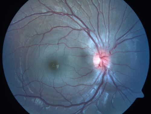 Central Serous Chorioretinopathy in a child
12-year-old African American Female A few weeks ago she felt like something was covering the right eye and she couldn't see well. She was told that she had a swollen optic nerve. She had a recent diagnosis of sinus infection. She also recently had onset menarche on August 7th. Eye problem started about a week before menarche. She's been getting some headaches, partly because of sinus infection. They started about a month ago and now are getting better. She is on zytrhomax for the sinus problem. Patient is hypothyroid and is on thyroid supplementation and that has been stable. She has no eye pain.
MEDS: Synthroid, Flonase
PMHx -  Thyroid Disease
VA OD: Dcc20/400 PH20/125 NccJ10
VA OS: Dcc20/20 NccJ1+
IOP: TP: OD:14 OS:21 

Macular detachments resolved in 1 month with no treatment and vision returned to 20/20 in one month and 20/16 in 2 months
