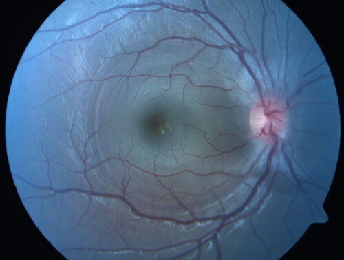 Central Serous Chorioretinopathy in a child
12-year-old African American Female A few weeks ago she felt like something was covering the right eye and she couldn't see well. She was told that she had a swollen optic nerve. She had a recent diagnosis of sinus infection. She also recently had onset menarche on August 7th. Eye problem started about a week before menarche. She's been getting some headaches, partly because of sinus infection. They started about a month ago and now are getting better. She is on zytrhomax for the sinus problem. Patient is hypothyroid and is on thyroid supplementation and that has been stable. She has no eye pain.
MEDS: Synthroid, Flonase
PMHx -  Thyroid Disease
VA OD: Dcc20/400 PH20/125 NccJ10
VA OS: Dcc20/20 NccJ1+
IOP: TP: OD:14 OS:21 

Macular detachments resolved in 1 month with no treatment and vision returned to 20/20 in one month and 20/16 in 2 months
