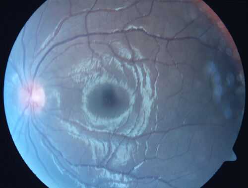 Central Serous Chorioretinopathy in a child
12-year-old African American Female A few weeks ago she felt like something was covering the right eye and she couldn't see well. She was told that she had a swollen optic nerve. She had a recent diagnosis of sinus infection. She also recently had onset menarche on August 7th. Eye problem started about a week before menarche. She's been getting some headaches, partly because of sinus infection. They started about a month ago and now are getting better. She is on zytrhomax for the sinus problem. Patient is hypothyroid and is on thyroid supplementation and that has been stable. She has no eye pain.
MEDS: Synthroid, Flonase
PMHx -  Thyroid Disease
VA OD: Dcc20/400 PH20/125 NccJ10
VA OS: Dcc20/20 NccJ1+
IOP: TP: OD:14 OS:21 

Macular detachments resolved in 1 month with no treatment and vision returned to 20/20 in one month and 20/16 in 2 months
