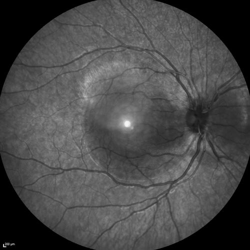 Central Serous Chorioretinopathy in a child
12-year-old African American Female A few weeks ago she felt like something was covering the right eye and she couldn't see well. She was told that she had a swollen optic nerve. She had a recent diagnosis of sinus infection. She also recently had onset menarche on August 7th. Eye problem started about a week before menarche. She's been getting some headaches, partly because of sinus infection. They started about a month ago and now are getting better. She is on zytrhomax for the sinus problem. Patient is hypothyroid and is on thyroid supplementation and that has been stable. She has no eye pain.
MEDS: Synthroid, Flonase
PMHx -  Thyroid Disease
VA OD: Dcc20/400 PH20/125 NccJ10
VA OS: Dcc20/20 NccJ1+
IOP: TP: OD:14 OS:21 

Macular detachments resolved in 1 month with no treatment and vision returned to 20/20 in one month and 20/16 in 2 months
