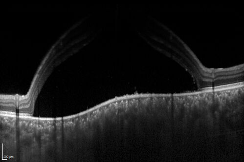 Central Serous Chorioretinopathy in a child
12-year-old African American Female A few weeks ago she felt like something was covering the right eye and she couldn't see well. She was told that she had a swollen optic nerve. She had a recent diagnosis of sinus infection. She also recently had onset menarche on August 7th. Eye problem started about a week before menarche. She's been getting some headaches, partly because of sinus infection. They started about a month ago and now are getting better. She is on zytrhomax for the sinus problem. Patient is hypothyroid and is on thyroid supplementation and that has been stable. She has no eye pain.
MEDS: Synthroid, Flonase
PMHx -  Thyroid Disease
VA OD: Dcc20/400 PH20/125 NccJ10
VA OS: Dcc20/20 NccJ1+
IOP: TP: OD:14 OS:21 

Macular detachments resolved in 1 month with no treatment and vision returned to 20/20 in one month and 20/16 in 2 months
