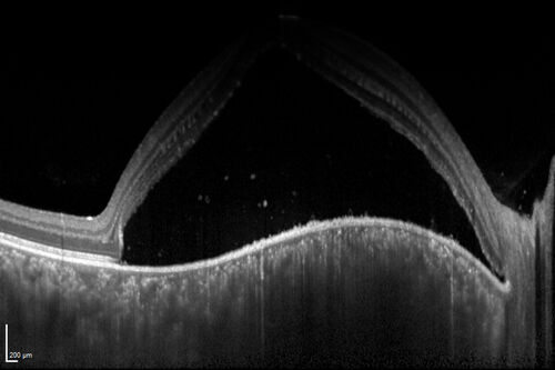 Central Serous Chorioretinopathy in a child
12-year-old African American Female A few weeks ago she felt like something was covering the right eye and she couldn't see well. She was told that she had a swollen optic nerve. She had a recent diagnosis of sinus infection. She also recently had onset menarche on August 7th. Eye problem started about a week before menarche. She's been getting some headaches, partly because of sinus infection. They started about a month ago and now are getting better. She is on zytrhomax for the sinus problem. Patient is hypothyroid and is on thyroid supplementation and that has been stable. She has no eye pain.
MEDS: Synthroid, Flonase
PMHx -  Thyroid Disease
VA OD: Dcc20/400 PH20/125 NccJ10
VA OS: Dcc20/20 NccJ1+
IOP: TP: OD:14 OS:21 

Macular detachments resolved in 1 month with no treatment and vision returned to 20/20 in one month and 20/16 in 2 months
