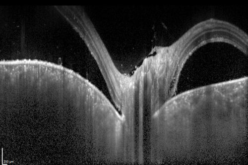 Central Serous Chorioretinopathy in a child
12-year-old African American Female A few weeks ago she felt like something was covering the right eye and she couldn't see well. She was told that she had a swollen optic nerve. She had a recent diagnosis of sinus infection. She also recently had onset menarche on August 7th. Eye problem started about a week before menarche. She's been getting some headaches, partly because of sinus infection. They started about a month ago and now are getting better. She is on zytrhomax for the sinus problem. Patient is hypothyroid and is on thyroid supplementation and that has been stable. She has no eye pain.
MEDS: Synthroid, Flonase
PMHx -  Thyroid Disease
VA OD: Dcc20/400 PH20/125 NccJ10
VA OS: Dcc20/20 NccJ1+
IOP: TP: OD:14 OS:21 

Macular detachments resolved in 1 month with no treatment and vision returned to 20/20 in one month and 20/16 in 2 months
