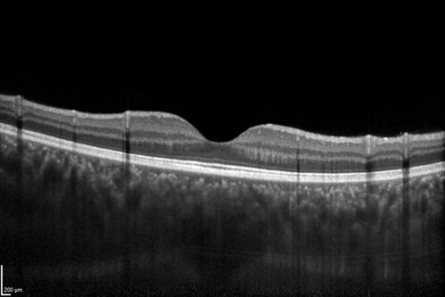 Central Serous Chorioretinopathy in a child
12-year-old African American Female A few weeks ago she felt like something was covering the right eye and she couldn't see well. She was told that she had a swollen optic nerve. She had a recent diagnosis of sinus infection. She also recently had onset menarche on August 7th. Eye problem started about a week before menarche. She's been getting some headaches, partly because of sinus infection. They started about a month ago and now are getting better. She is on zytrhomax for the sinus problem. Patient is hypothyroid and is on thyroid supplementation and that has been stable. She has no eye pain.
MEDS: Synthroid, Flonase
PMHx -  Thyroid Disease
VA OD: Dcc20/400 PH20/125 NccJ10
VA OS: Dcc20/20 NccJ1+
IOP: TP: OD:14 OS:21 

Macular detachments resolved in 1 month with no treatment and vision returned to 20/20 in one month and 20/16 in 2 months
