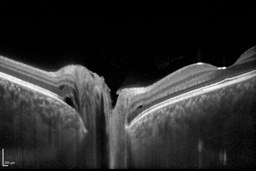 Central Serous Chorioretinopathy in a child
12-year-old African American Female A few weeks ago she felt like something was covering the right eye and she couldn't see well. She was told that she had a swollen optic nerve. She had a recent diagnosis of sinus infection. She also recently had onset menarche on August 7th. Eye problem started about a week before menarche. She's been getting some headaches, partly because of sinus infection. They started about a month ago and now are getting better. She is on zytrhomax for the sinus problem. Patient is hypothyroid and is on thyroid supplementation and that has been stable. She has no eye pain.
MEDS: Synthroid, Flonase
PMHx -  Thyroid Disease
VA OD: Dcc20/400 PH20/125 NccJ10
VA OS: Dcc20/20 NccJ1+
IOP: TP: OD:14 OS:21 

Macular detachments resolved in 1 month with no treatment and vision returned to 20/20 in one month and 20/16 in 2 months
