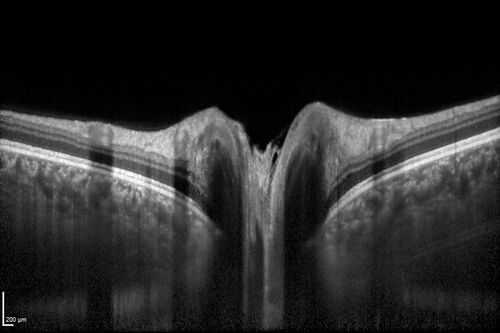 Central Serous Chorioretinopathy in a child
12-year-old African American Female A few weeks ago she felt like something was covering the right eye and she couldn't see well. She was told that she had a swollen optic nerve. She had a recent diagnosis of sinus infection. She also recently had onset menarche on August 7th. Eye problem started about a week before menarche. She's been getting some headaches, partly because of sinus infection. They started about a month ago and now are getting better. She is on zytrhomax for the sinus problem. Patient is hypothyroid and is on thyroid supplementation and that has been stable. She has no eye pain.
MEDS: Synthroid, Flonase
PMHx -  Thyroid Disease
VA OD: Dcc20/400 PH20/125 NccJ10
VA OS: Dcc20/20 NccJ1+
IOP: TP: OD:14 OS:21 

Macular detachments resolved in 1 month with no treatment and vision returned to 20/20 in one month and 20/16 in 2 months
