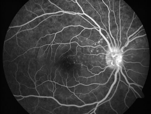 Central Serous Chorioretinopathy in a child
12-year-old African American Female A few weeks ago she felt like something was covering the right eye and she couldn't see well. She was told that she had a swollen optic nerve. She had a recent diagnosis of sinus infection. She also recently had onset menarche on August 7th. Eye problem started about a week before menarche. She's been getting some headaches, partly because of sinus infection. They started about a month ago and now are getting better. She is on zytrhomax for the sinus problem. Patient is hypothyroid and is on thyroid supplementation and that has been stable. She has no eye pain.
MEDS: Synthroid, Flonase
PMHx -  Thyroid Disease
VA OD: Dcc20/400 PH20/125 NccJ10
VA OS: Dcc20/20 NccJ1+
IOP: TP: OD:14 OS:21 

Macular detachments resolved in 1 month with no treatment and vision returned to 20/20 in one month and 20/16 in 2 months
