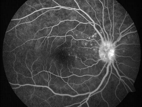 Central Serous Chorioretinopathy in a child
12-year-old African American Female A few weeks ago she felt like something was covering the right eye and she couldn't see well. She was told that she had a swollen optic nerve. She had a recent diagnosis of sinus infection. She also recently had onset menarche on August 7th. Eye problem started about a week before menarche. She's been getting some headaches, partly because of sinus infection. They started about a month ago and now are getting better. She is on zytrhomax for the sinus problem. Patient is hypothyroid and is on thyroid supplementation and that has been stable. She has no eye pain.
MEDS: Synthroid, Flonase
PMHx -  Thyroid Disease
VA OD: Dcc20/400 PH20/125 NccJ10
VA OS: Dcc20/20 NccJ1+
IOP: TP: OD:14 OS:21 

Macular detachments resolved in 1 month with no treatment and vision returned to 20/20 in one month and 20/16 in 2 months
