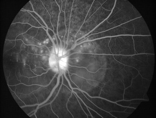 Central Serous Chorioretinopathy in a child
12-year-old African American Female A few weeks ago she felt like something was covering the right eye and she couldn't see well. She was told that she had a swollen optic nerve. She had a recent diagnosis of sinus infection. She also recently had onset menarche on August 7th. Eye problem started about a week before menarche. She's been getting some headaches, partly because of sinus infection. They started about a month ago and now are getting better. She is on zytrhomax for the sinus problem. Patient is hypothyroid and is on thyroid supplementation and that has been stable. She has no eye pain.
MEDS: Synthroid, Flonase
PMHx -  Thyroid Disease
VA OD: Dcc20/400 PH20/125 NccJ10
VA OS: Dcc20/20 NccJ1+
IOP: TP: OD:14 OS:21 

Macular detachments resolved in 1 month with no treatment and vision returned to 20/20 in one month and 20/16 in 2 months
