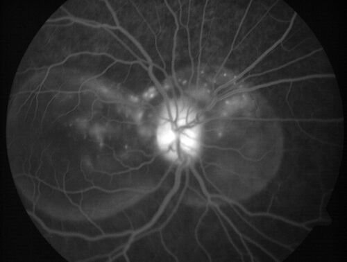 Central Serous Chorioretinopathy in a child
12-year-old African American Female A few weeks ago she felt like something was covering the right eye and she couldn't see well. She was told that she had a swollen optic nerve. She had a recent diagnosis of sinus infection. She also recently had onset menarche on August 7th. Eye problem started about a week before menarche. She's been getting some headaches, partly because of sinus infection. They started about a month ago and now are getting better. She is on zytrhomax for the sinus problem. Patient is hypothyroid and is on thyroid supplementation and that has been stable. She has no eye pain.
MEDS: Synthroid, Flonase
PMHx -  Thyroid Disease
VA OD: Dcc20/400 PH20/125 NccJ10
VA OS: Dcc20/20 NccJ1+
IOP: TP: OD:14 OS:21 

Macular detachments resolved in 1 month with no treatment and vision returned to 20/20 in one month and 20/16 in 2 months
