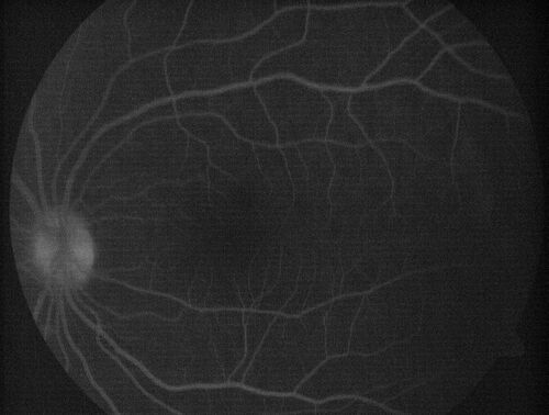 Central Serous Chorioretinopathy in a child
12-year-old African American Female A few weeks ago she felt like something was covering the right eye and she couldn't see well. She was told that she had a swollen optic nerve. She had a recent diagnosis of sinus infection. She also recently had onset menarche on August 7th. Eye problem started about a week before menarche. She's been getting some headaches, partly because of sinus infection. They started about a month ago and now are getting better. She is on zytrhomax for the sinus problem. Patient is hypothyroid and is on thyroid supplementation and that has been stable. She has no eye pain.
MEDS: Synthroid, Flonase
PMHx -  Thyroid Disease
VA OD: Dcc20/400 PH20/125 NccJ10
VA OS: Dcc20/20 NccJ1+
IOP: TP: OD:14 OS:21 

Macular detachments resolved in 1 month with no treatment and vision returned to 20/20 in one month and 20/16 in 2 months
