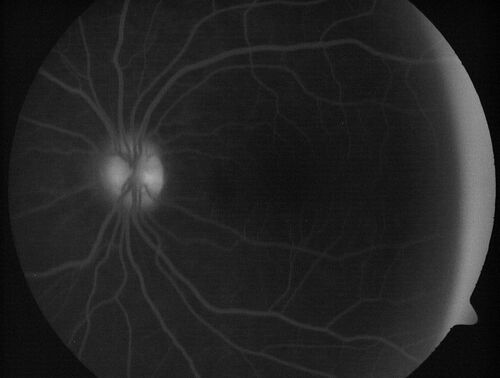 Central Serous Chorioretinopathy in a child
12-year-old African American Female A few weeks ago she felt like something was covering the right eye and she couldn't see well. She was told that she had a swollen optic nerve. She had a recent diagnosis of sinus infection. She also recently had onset menarche on August 7th. Eye problem started about a week before menarche. She's been getting some headaches, partly because of sinus infection. They started about a month ago and now are getting better. She is on zytrhomax for the sinus problem. Patient is hypothyroid and is on thyroid supplementation and that has been stable. She has no eye pain.
MEDS: Synthroid, Flonase
PMHx -  Thyroid Disease
VA OD: Dcc20/400 PH20/125 NccJ10
VA OS: Dcc20/20 NccJ1+
IOP: TP: OD:14 OS:21 

Macular detachments resolved in 1 month with no treatment and vision returned to 20/20 in one month and 20/16 in 2 months

