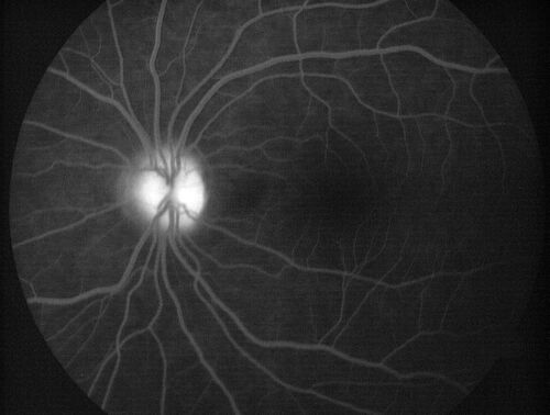 Central Serous Chorioretinopathy in a child
12-year-old African American Female A few weeks ago she felt like something was covering the right eye and she couldn't see well. She was told that she had a swollen optic nerve. She had a recent diagnosis of sinus infection. She also recently had onset menarche on August 7th. Eye problem started about a week before menarche. She's been getting some headaches, partly because of sinus infection. They started about a month ago and now are getting better. She is on zytrhomax for the sinus problem. Patient is hypothyroid and is on thyroid supplementation and that has been stable. She has no eye pain.
MEDS: Synthroid, Flonase
PMHx -  Thyroid Disease
VA OD: Dcc20/400 PH20/125 NccJ10
VA OS: Dcc20/20 NccJ1+
IOP: TP: OD:14 OS:21 

Macular detachments resolved in 1 month with no treatment and vision returned to 20/20 in one month and 20/16 in 2 months
