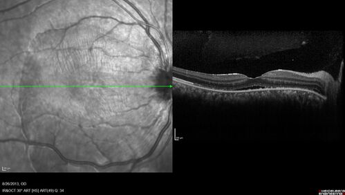 Central Serous Chorioretinopathy in a child
12-year-old African American Female A few weeks ago she felt like something was covering the right eye and she couldn't see well. She was told that she had a swollen optic nerve. She had a recent diagnosis of sinus infection. She also recently had onset menarche on August 7th. Eye problem started about a week before menarche. She's been getting some headaches, partly because of sinus infection. They started about a month ago and now are getting better. She is on zytrhomax for the sinus problem. Patient is hypothyroid and is on thyroid supplementation and that has been stable. She has no eye pain.
MEDS: Synthroid, Flonase
PMHx -  Thyroid Disease
VA OD: Dcc20/400 PH20/125 NccJ10
VA OS: Dcc20/20 NccJ1+
IOP: TP: OD:14 OS:21 

Macular detachments resolved in 1 month with no treatment and vision returned to 20/20 in one month and 20/16 in 2 months

