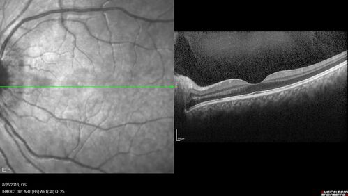 Central Serous Chorioretinopathy in a child
12-year-old African American Female A few weeks ago she felt like something was covering the right eye and she couldn't see well. She was told that she had a swollen optic nerve. She had a recent diagnosis of sinus infection. She also recently had onset menarche on August 7th. Eye problem started about a week before menarche. She's been getting some headaches, partly because of sinus infection. They started about a month ago and now are getting better. She is on zytrhomax for the sinus problem. Patient is hypothyroid and is on thyroid supplementation and that has been stable. She has no eye pain.
MEDS: Synthroid, Flonase
PMHx -  Thyroid Disease
VA OD: Dcc20/400 PH20/125 NccJ10
VA OS: Dcc20/20 NccJ1+
IOP: TP: OD:14 OS:21 

Macular detachments resolved in 1 month with no treatment and vision returned to 20/20 in one month and 20/16 in 2 months
