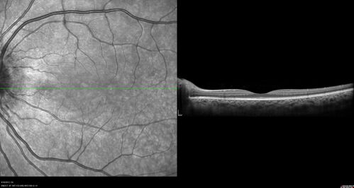 Central Serous Chorioretinopathy in a child
12-year-old African American Female A few weeks ago she felt like something was covering the right eye and she couldn't see well. She was told that she had a swollen optic nerve. She had a recent diagnosis of sinus infection. She also recently had onset menarche on August 7th. Eye problem started about a week before menarche. She's been getting some headaches, partly because of sinus infection. They started about a month ago and now are getting better. She is on zytrhomax for the sinus problem. Patient is hypothyroid and is on thyroid supplementation and that has been stable. She has no eye pain.
MEDS: Synthroid, Flonase
PMHx -  Thyroid Disease
VA OD: Dcc20/400 PH20/125 NccJ10
VA OS: Dcc20/20 NccJ1+
IOP: TP: OD:14 OS:21 

Macular detachments resolved in 1 month with no treatment and vision returned to 20/20 in one month and 20/16 in 2 months
