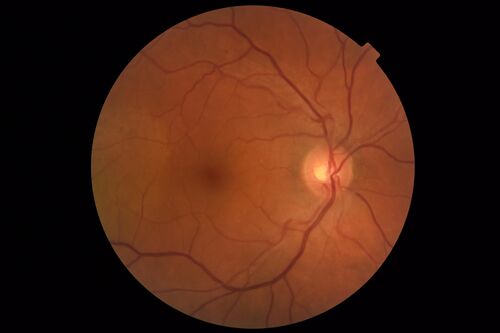 Bilateral Acute Central Serous Chorioretinopathy - Evidence of old disease OS
64 year old man  noticed in the right eye that is a black spot 4 days ago.  Also vertical lines in his kitchen were a little wavy. He is not on any steroid medications.  He has vertigo. 
VA OD: Dcc20/25-2 NccJ1+-3
VA OS: Dcc20/32-1 PHNI NccJ5-1
IOP: TP: OD:12 OS:15

