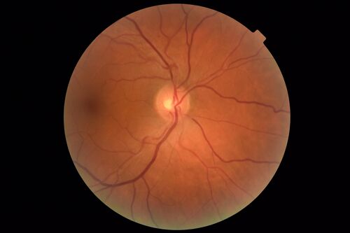 Bilateral Acute Central Serous Chorioretinopathy - Evidence of old disease OS
64 year old man  noticed in the right eye that is a black spot 4 days ago.  Also vertical lines in his kitchen were a little wavy. He is not on any steroid medications.  He has vertigo. 
VA OD: Dcc20/25-2 NccJ1+-3
VA OS: Dcc20/32-1 PHNI NccJ5-1
IOP: TP: OD:12 OS:15
