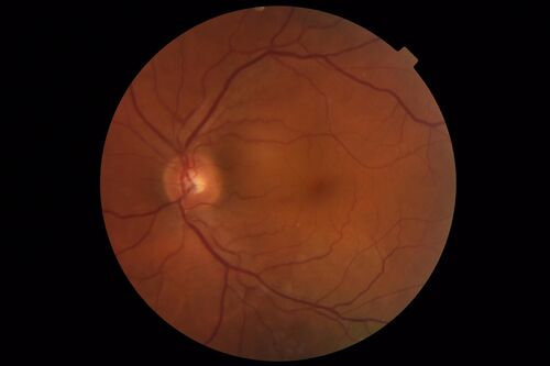 Bilateral Acute Central Serous Chorioretinopathy - Evidence of old disease OS
64 year old man  noticed in the right eye that is a black spot 4 days ago.  Also vertical lines in his kitchen were a little wavy. He is not on any steroid medications.  He has vertigo. 
VA OD: Dcc20/25-2 NccJ1+-3
VA OS: Dcc20/32-1 PHNI NccJ5-1
IOP: TP: OD:12 OS:15
