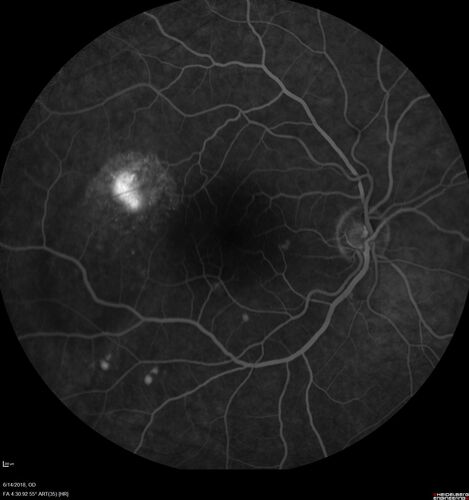 Bilateral Acute Central Serous Chorioretinopathy - Evidence of old disease OS
64 year old man  noticed in the right eye that is a black spot 4 days ago.  Also vertical lines in his kitchen were a little wavy. He is not on any steroid medications.  He has vertigo. 
VA OD: Dcc20/25-2 NccJ1+-3
VA OS: Dcc20/32-1 PHNI NccJ5-1
IOP: TP: OD:12 OS:15
