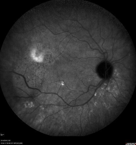 Bilateral Acute Central Serous Chorioretinopathy - Evidence of old disease OS
64 year old man  noticed in the right eye that is a black spot 4 days ago.  Also vertical lines in his kitchen were a little wavy. He is not on any steroid medications.  He has vertigo. 
VA OD: Dcc20/25-2 NccJ1+-3
VA OS: Dcc20/32-1 PHNI NccJ5-1
IOP: TP: OD:12 OS:15
