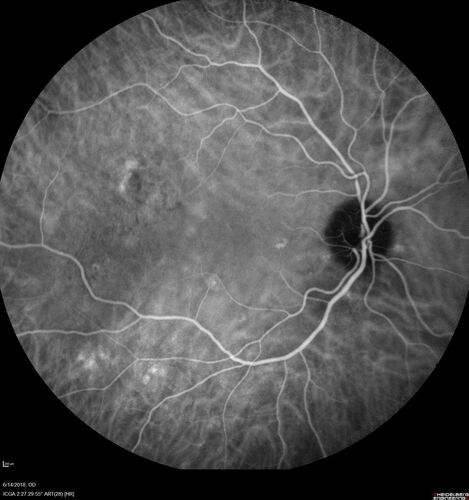 Bilateral Acute Central Serous Chorioretinopathy - Evidence of old disease OS
64 year old man  noticed in the right eye that is a black spot 4 days ago.  Also vertical lines in his kitchen were a little wavy. He is not on any steroid medications.  He has vertigo. 
VA OD: Dcc20/25-2 NccJ1+-3
VA OS: Dcc20/32-1 PHNI NccJ5-1
IOP: TP: OD:12 OS:15
