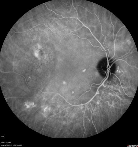 Bilateral Acute Central Serous Chorioretinopathy - Evidence of old disease OS
64 year old man  noticed in the right eye that is a black spot 4 days ago.  Also vertical lines in his kitchen were a little wavy. He is not on any steroid medications.  He has vertigo. 
VA OD: Dcc20/25-2 NccJ1+-3
VA OS: Dcc20/32-1 PHNI NccJ5-1
IOP: TP: OD:12 OS:15
