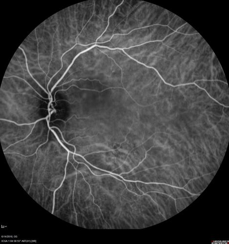 Bilateral Acute Central Serous Chorioretinopathy - Evidence of old disease OS
64 year old man  noticed in the right eye that is a black spot 4 days ago.  Also vertical lines in his kitchen were a little wavy. He is not on any steroid medications.  He has vertigo. 
VA OD: Dcc20/25-2 NccJ1+-3
VA OS: Dcc20/32-1 PHNI NccJ5-1
IOP: TP: OD:12 OS:15
