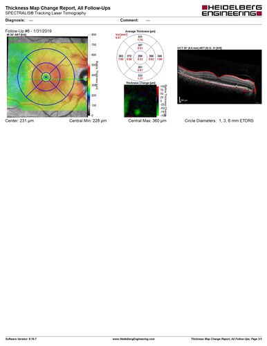 Bilateral Acute Central Serous Chorioretinopathy - Evidence of old disease OS
64 year old man  noticed in the right eye that is a black spot 4 days ago.  Also vertical lines in his kitchen were a little wavy. He is not on any steroid medications.  He has vertigo. 
VA OD: Dcc20/25-2 NccJ1+-3
VA OS: Dcc20/32-1 PHNI NccJ5-1
IOP: TP: OD:12 OS:15
