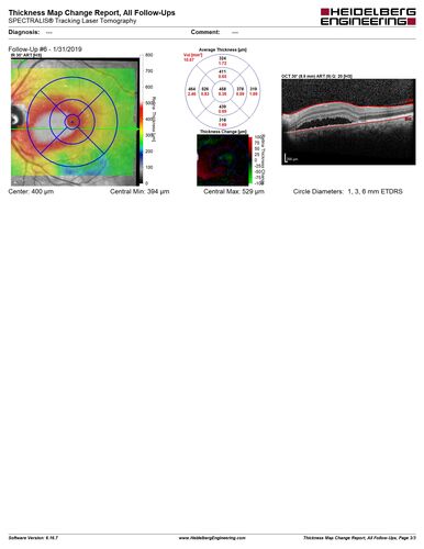 Bilateral Acute Central Serous Chorioretinopathy - Evidence of old disease OS
64 year old man  noticed in the right eye that is a black spot 4 days ago.  Also vertical lines in his kitchen were a little wavy. He is not on any steroid medications.  He has vertigo. 
VA OD: Dcc20/25-2 NccJ1+-3
VA OS: Dcc20/32-1 PHNI NccJ5-1
IOP: TP: OD:12 OS:15
