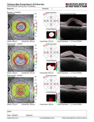 Central Serous Chorioretinopathy - Expanding hot spot - photodynamic laser
35 year old man with acute central serous chorioretinopathy.  The fluid got better then worse and the patient was treated with full strength juxtafoveal PDT and then got better.
