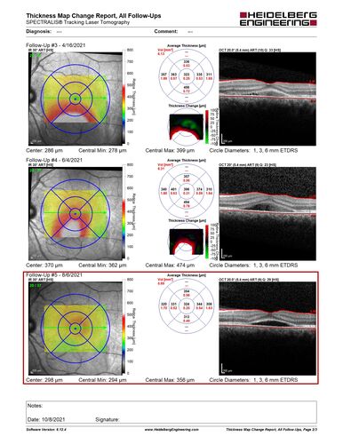 Central Serous Chorioretinopathy - Expanding hot spot - photodynamic laser
35 year old man with acute central serous chorioretinopathy.  The fluid got better then worse and the patient was treated with full strength juxtafoveal PDT and then got better.
