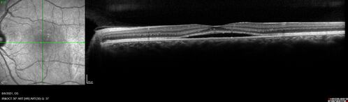 Central Serous Chorioretinopathy - Expanding hot spot - photodynamic laser
35 year old man with acute central serous chorioretinopathy.  The fluid got better then worse and the patient was treated with full strength juxtafoveal PDT and then got better.
