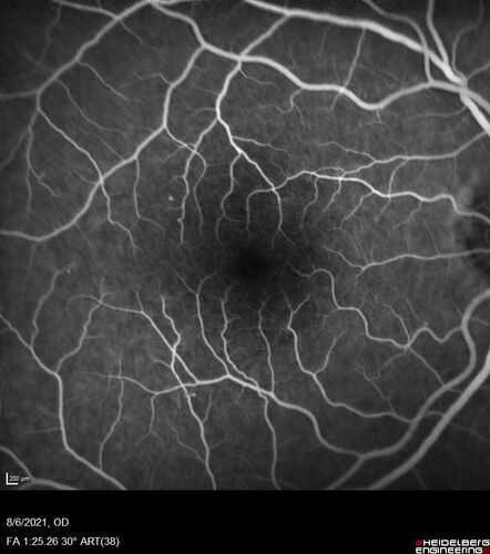 Central Serous Chorioretinopathy - Expanding hot spot - photodynamic laser
35 year old man with acute central serous chorioretinopathy.  The fluid got better then worse and the patient was treated with full strength juxtafoveal PDT and then got better.
