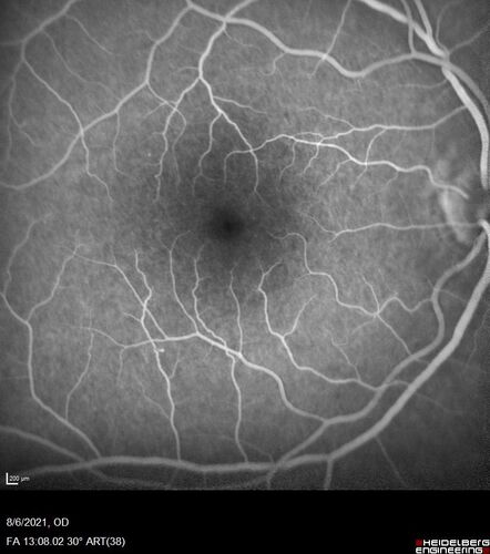 Central Serous Chorioretinopathy - Expanding hot spot - photodynamic laser
35 year old man with acute central serous chorioretinopathy.  The fluid got better then worse and the patient was treated with full strength juxtafoveal PDT and then got better.
