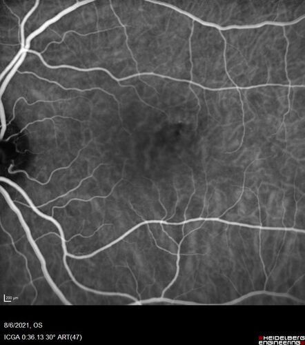 Central Serous Chorioretinopathy - Expanding hot spot - photodynamic laser
35 year old man with acute central serous chorioretinopathy.  The fluid got better then worse and the patient was treated with full strength juxtafoveal PDT and then got better.
